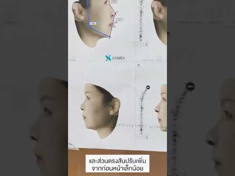 แก้จมูกที่เอียงมา 30 ปี 