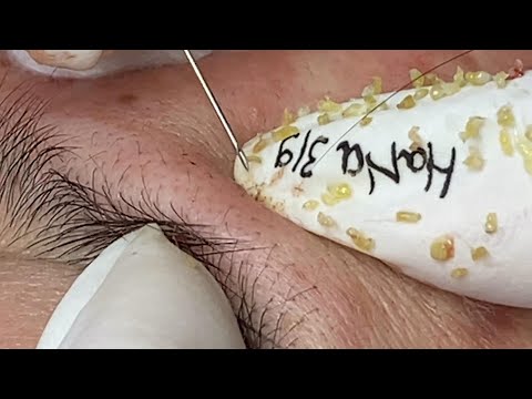 Loan Nguyen Acne Treatment (#121)