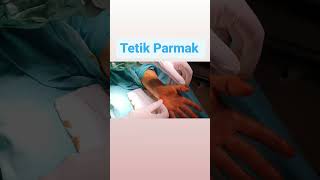 Tetik Parmak: Belirtileri, Nedenleri ve Tedavi Yöntemleri Bursa Medica