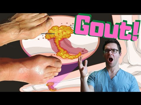 Gout Attack in the Big Toe Joint Foot Diet Treatment 2 MINUTES
