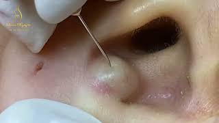 Big pimple in the ear  || GoPimple