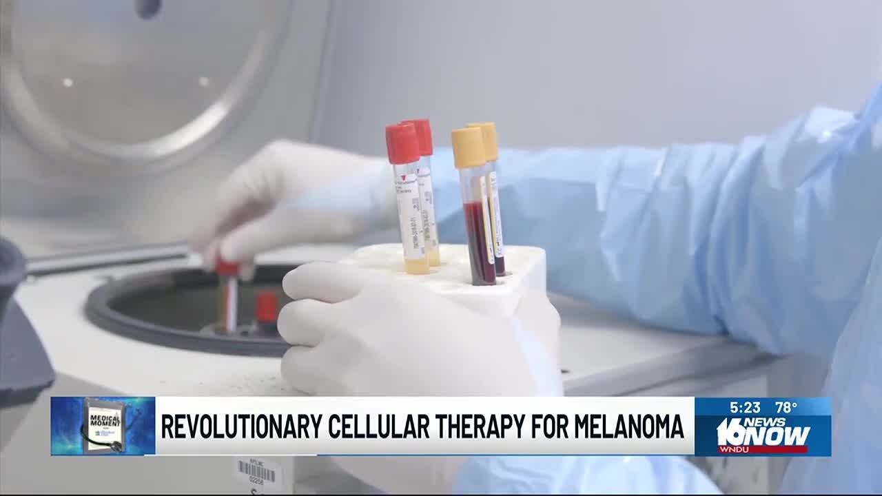Medical Moment: Revolutionary therapy for melanoma