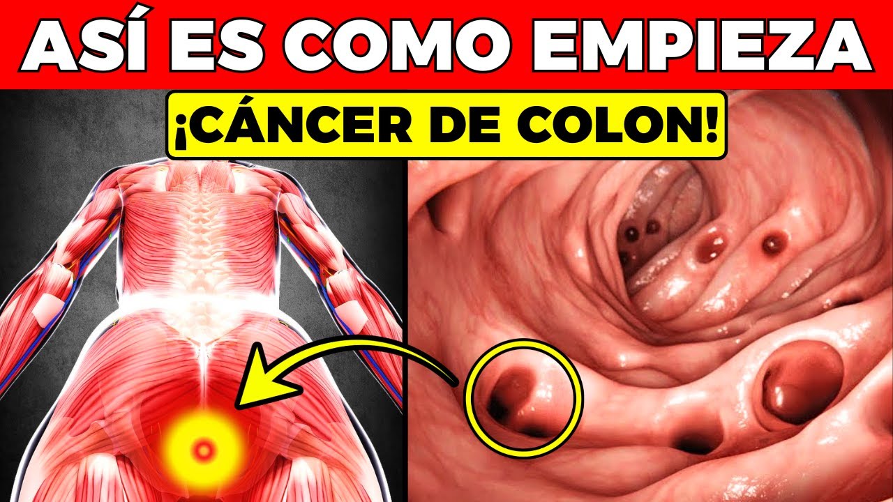 ¡ALERTA! 7 SEÑALES que indican la PRESENCIA de CÁNCER DE COLON en tu CUERPO