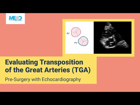 Evaluating Transposition of the Great Arteries (TGA) Pre-Surgery with Echocardiography