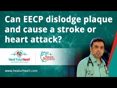 Can EECP dislodge plaque and cause stroke or heart attack?