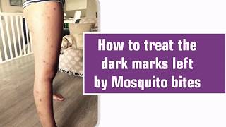 How to treat the dark marks left by Mosquito bites.