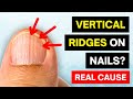 That's The REAL Cause of VERTICAL RIDGES On Your Nails