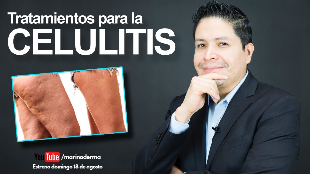 TRATAMIENTOS PARA LA CELULITIS. ¿Como eliminar celulitis Dr. Marino Dermatologo