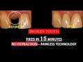 How to save broken teeth | What is post and core ?