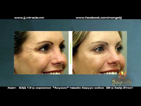 J J miracle   Filler