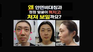 [안면비대칭] 볼꺼짐, 볼처짐, 눈주위·관자놀이 꺼짐 원인과 해결 (필러 전 필독!) 대진당 기클리닉
