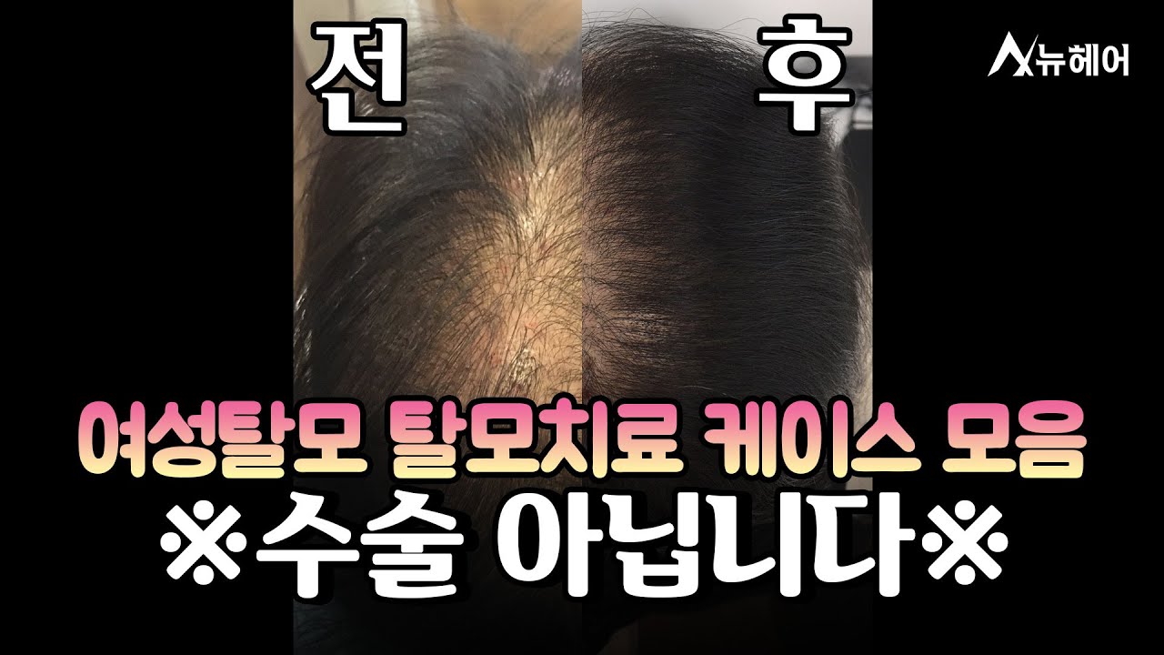 女性头顶脱发发变得浓密。 无需修改即可显示结果。ㅣNew Hair