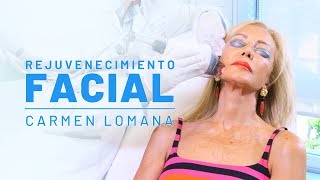 Rejuvenecimiento Facial de Carmen Lomana | Láser Fraxel en Clínicas Diego de León