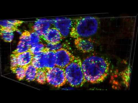21 Month-Old Human Lung 17235 Containing Homozygous Missence ABCA3 Mutation 21 Month-Old Human Lung 17235 Containing Homozygous Missence ABCA3 Mutation