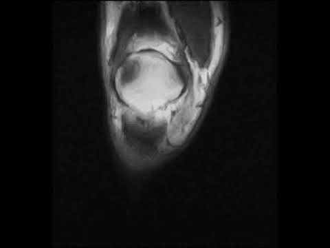 Dolori articolari è muscolo Tipo di giunzione ed esempi