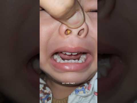 Something Stuck In Nose 😵  | How Doctor Remove It |        #shorts