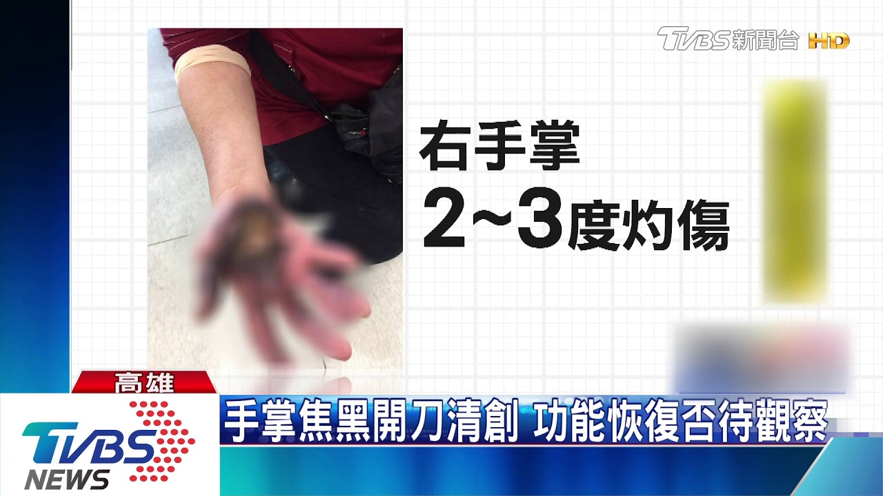 全家慕韓遊旗津 婦手摸電桿焦黑住院