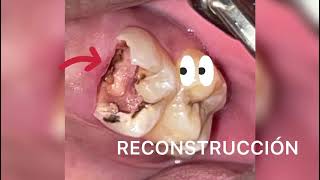 RECONSTRUCCION DENTAL #26
