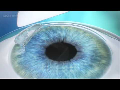 LASEK-PRK Procedure Animation