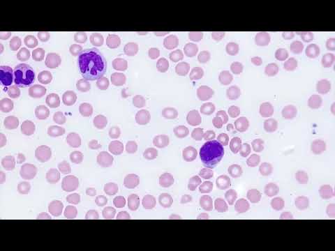 Hematopathology-Myeloid-CML.mp4