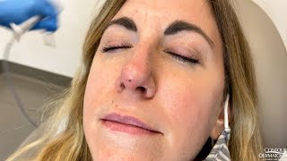 Removing a Small Bump on the Nose (Fibrous Papule)
