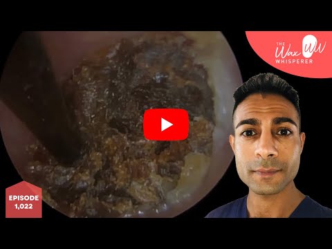1,022 - Hard Keratosis Obturans & Ear Wax Chiseled Out