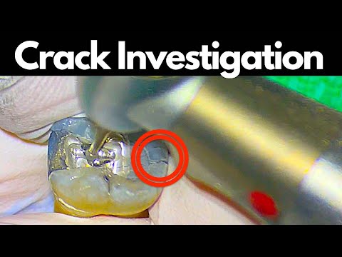 Mandibular Molar Access - Crack Investigation