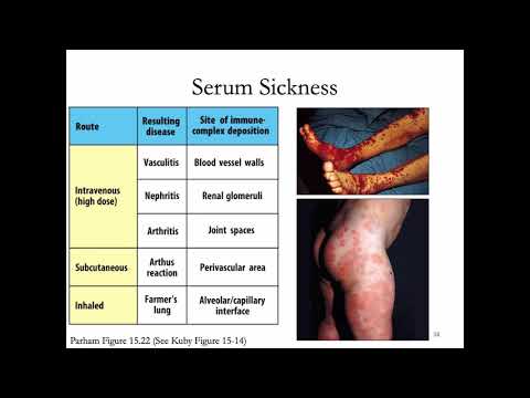 Immunology Lecture 31: Hypersensitivity (Allergy) 2 and Immunotherapies