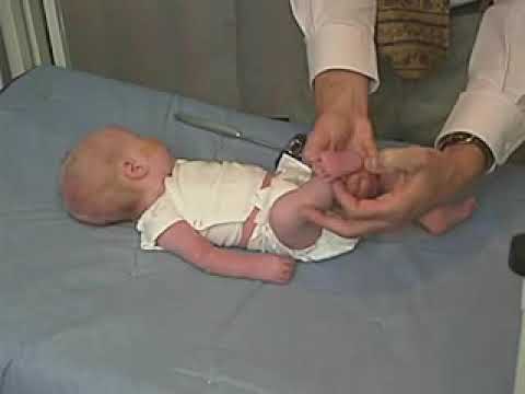 4.21 - Plantar Reflex - Newborn Abnormal - Infant Clinical Examination(MRCP)