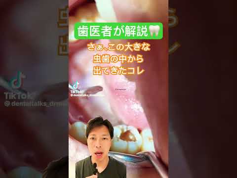 巨大口のためのバンジーコード神経