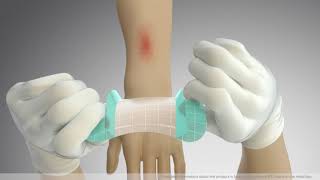 Product video: Coloplast Comfeel Plus Ulcer Hydrocolloid Dressings