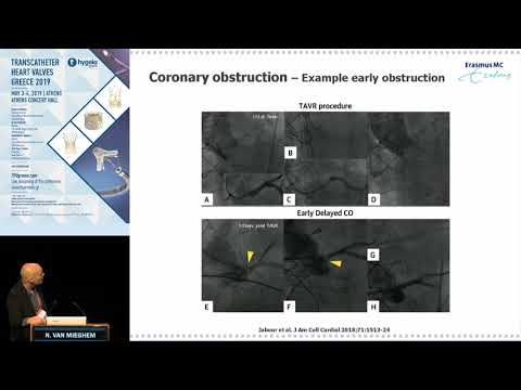 N. Van Mieghem | Mechanisms of coronary obstruction during TAVR.