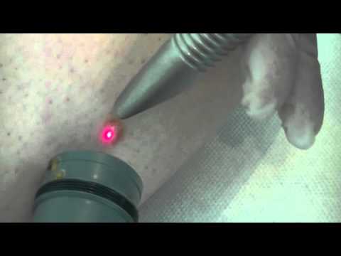 comment soigner un kist synovial