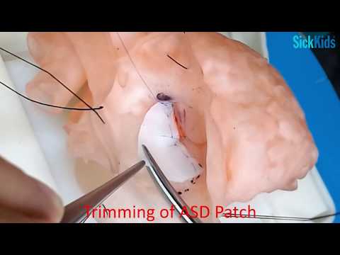 HOST - Complete AVSD Repair (2 patch sandwich technique) on a 3D-printed heart - Dr John G Coles
