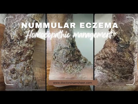 Nummular eczema, also known as nummular dermatitis or discoid eczema