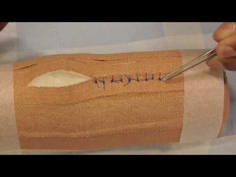Suture Removal - simple interrupted