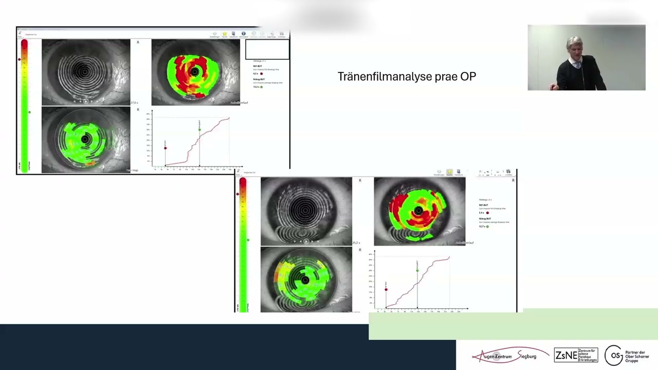 Wann Laser, wann RLE, wann 'Finger davon'?