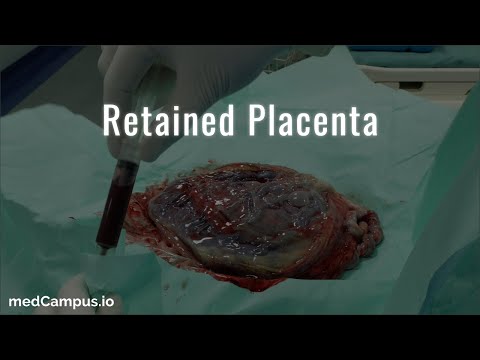 Retained Placenta Management