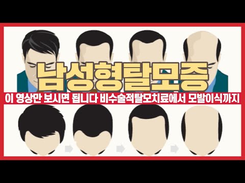 남성형탈모증 프로페시아 아보다트 약물치료 루트 탈모치료 프로그램 모발이식까지 이것만 아시면 됩니다. 루트원장 조성인피부과전문의가 소개합니다.