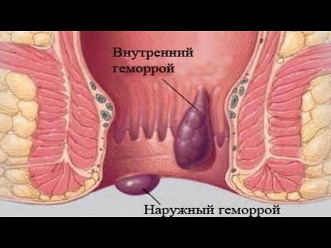 Мучает шейный остеохондроз Вестибулопатия остеохондроз шейного отдела