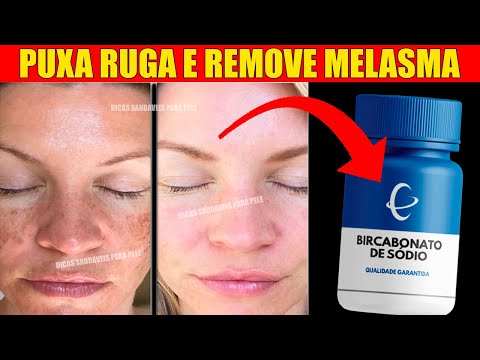 Adeus MELASMA! Dica POTENTE para ELIMINAR as MANCHAS, CLAREAR a PELE do ROSTO, COMBATER as RUGAS