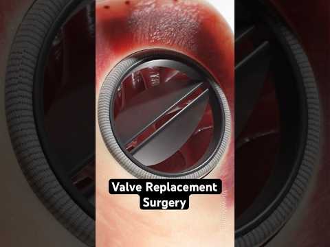 How surgeons replace a heart valve (3D Animation)