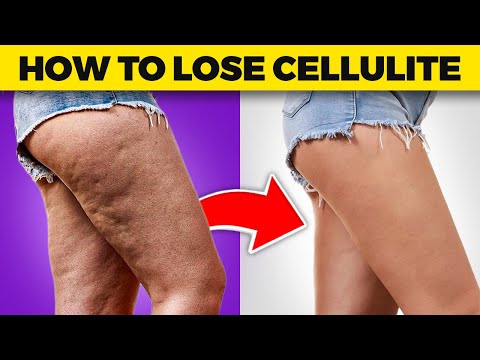 Cellulite Be Gone: Dr. Berg's Expert Tips on Losing Thigh and Buttock Cellulite