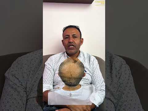 A Yemeni Patient Shares His Hair Transplant Experience in Cairo, Egypt at Change Me Clinic