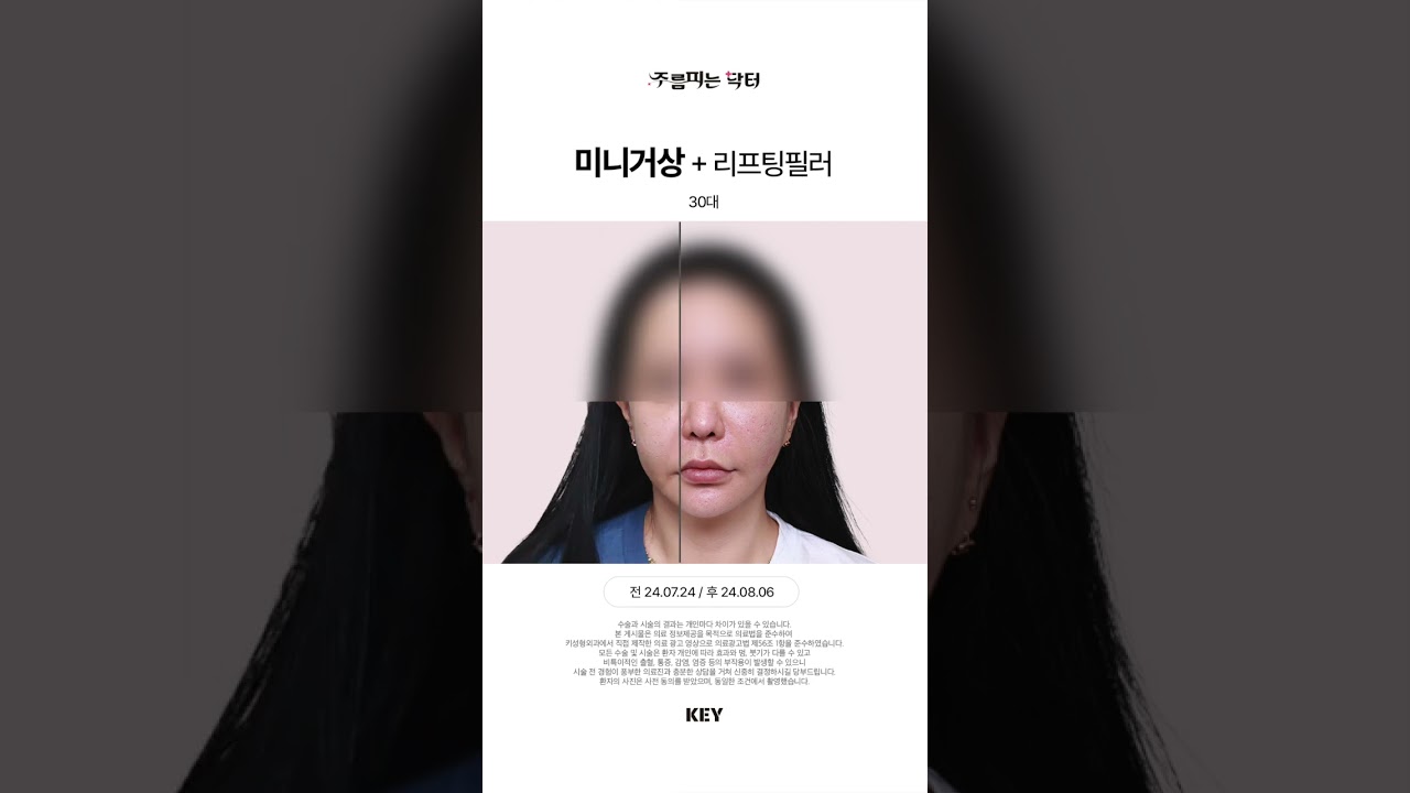 30대의 미니거상 미니리프팅 대구키성형외과