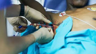 #Chest #tube insertion procedure for #Pneumothorax : Step by step