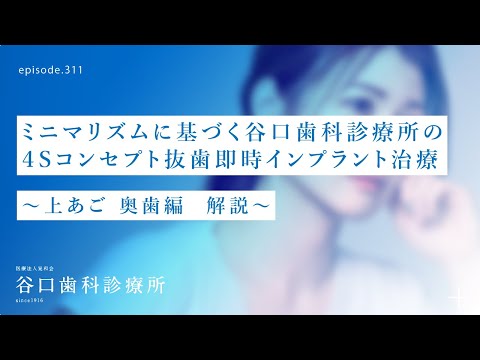 第311話  上あご 奥歯へのミニマリズムに基づく４Sコンセプト抜歯即時インプラント治療-解説編