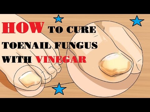 Isang gel polish pagpapagaling kuko Sa paggamot ng kuko halamang-singaw m