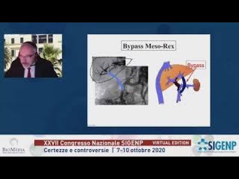 MesoRex e cavernoma della vena porta – Mesorex Bypass