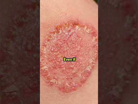 One Common Mistake Fungal Infection | Dr. Deepika Lunawat